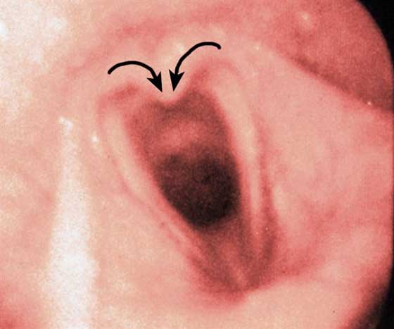 Abnormal arytenoid 'infolding' (arrows) on midline that became more accentuated with nasal occlusion.