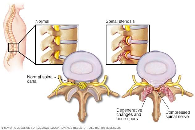 Spinal stenosis - Mayo Clinic