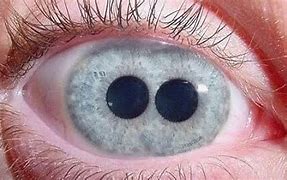 penyakit pada pupil mata - polycoria