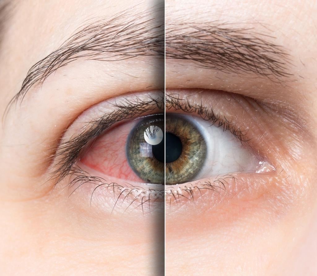 Глаз с синдромом сухого глаза