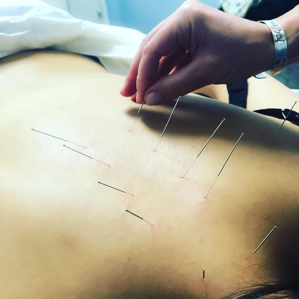 Irina says that "nearly 8 out of 10 people suffer from back pain at some point during their life. It is one of the top reasons people seek out medical care. The good news is, acupuncture can help."