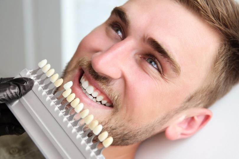 same-day teeth whitening in Vancouver 