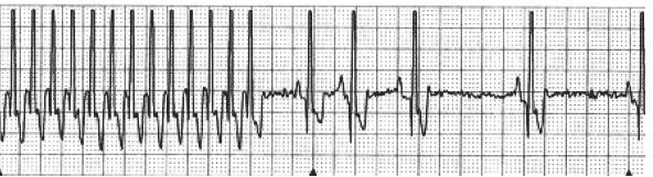 A lead II ECG rhythm strip obtained from a 1–year-old golden retriever