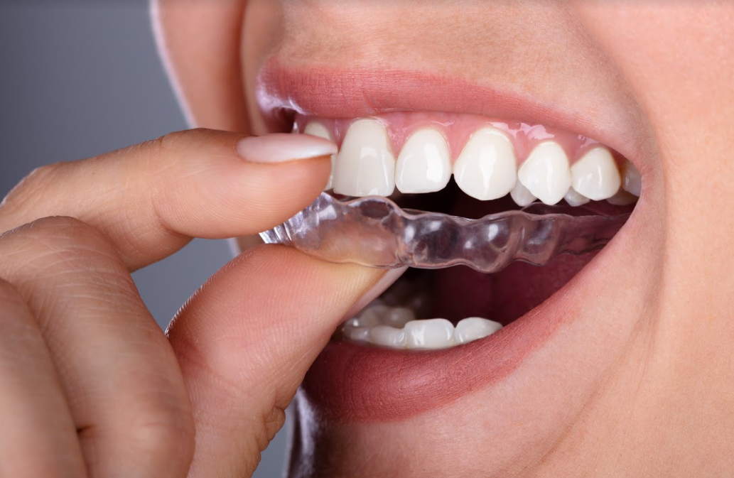 Aparat dentar invizibil | Clinica dentara Neoclinique