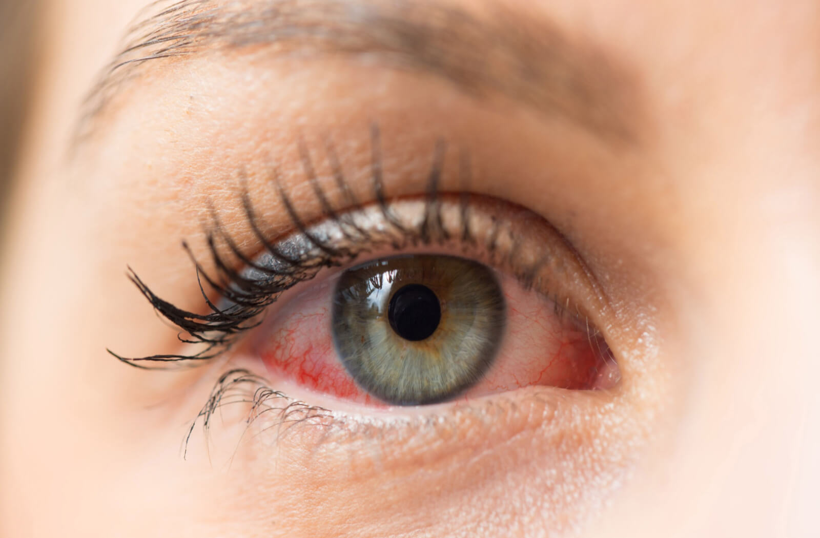 a close up of a womans eye which is red and puffy due to dry eye
