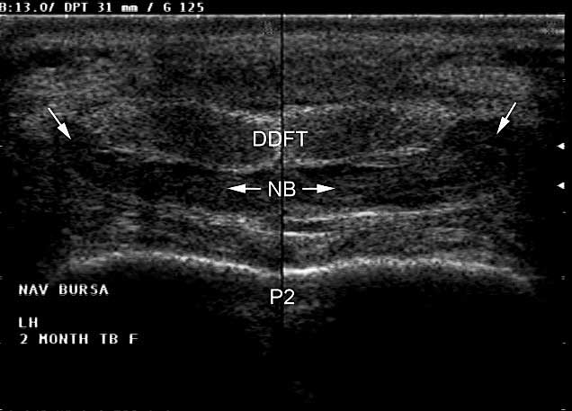 Septic navicular bursitis in a 2-month-old foal showing severe synovial thickening and minimal fluid pocketing