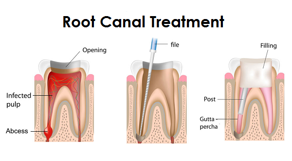 http://dentistpalakkad.com/endodontics/