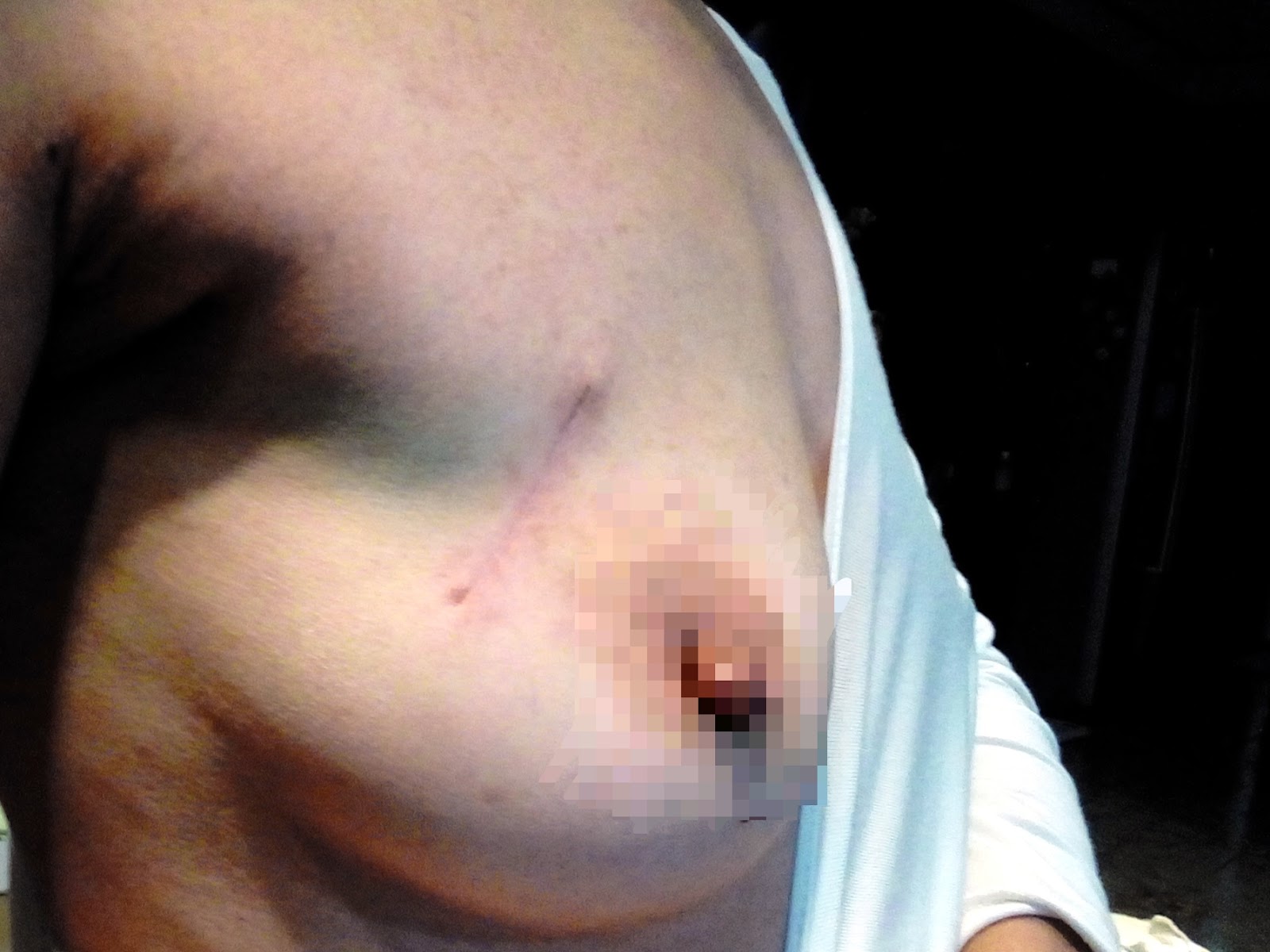 乳癌局切 放療比全切危險嗎 乳癌沒有全切會危險嗎 下集 蘇菲向前行 痞客邦
