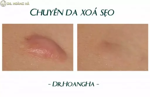 Hình dạng sẹo lồi trước và sau khi can thiệp phẫu thuật xóa sẹo tại Dr Hoàng Hà