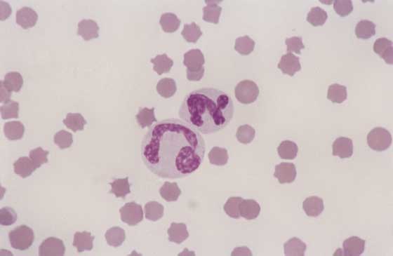 Feline blood. Inflammation can produce changes in neutrophil morphology. Two segmented neutrophils are present that have a slight increase in cytoplasmic basophilia. One of the neutrophils is very large and has abnormal nuclear lobulation which is a sign of toxic change (100x).