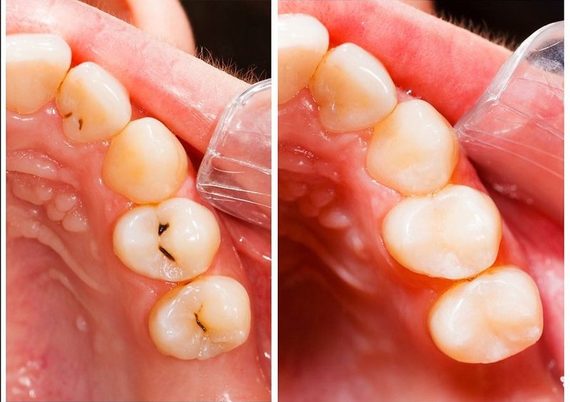 Vật liệu Composite có màu sắc tương tự màu răng thật