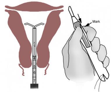 Retracting slider and expelling the IUD from inser