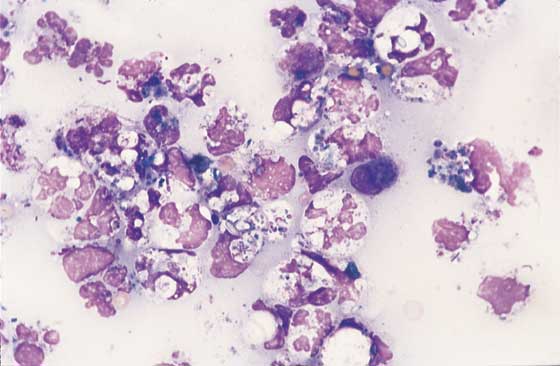Abdominal fluid. Numerous degenerate neutrophils that contain a mixed population of phagocytosed bacteria are present in a proteinaceous background. Cytologic findings confirm septic peritonitis (100x).