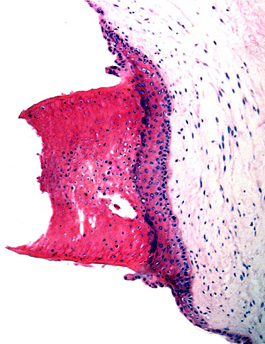 Keratinized squamous plaque on umbilical cord surface
