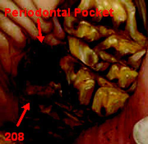 208 rotated into the dental arcade with a periodontal pocket at the interproximal space of 207/208 (11.0 yr old).