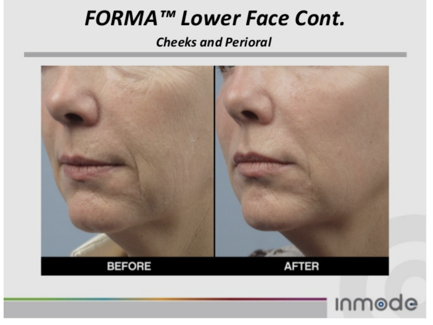 The Top 5 Nonsurgical Facelift Treatments Revitalyze MD