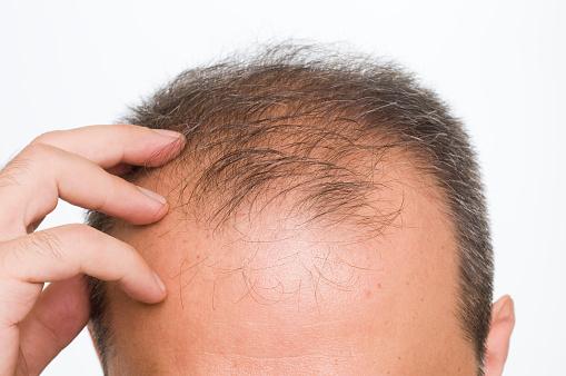 What STD Causes Hair Loss?
