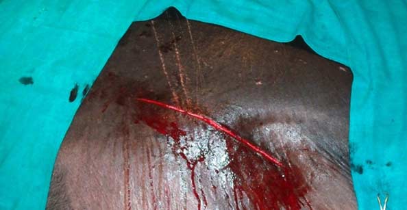 Skin incision in a buffalo (paramedian approach) during c-section.