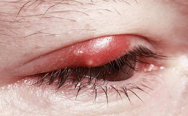 Hình ảnh lẹo ở mắt