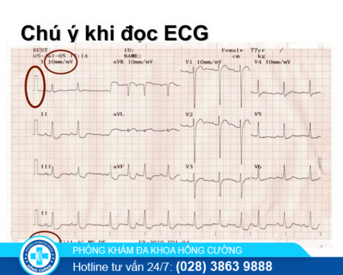 Sức khỏe, đời sống: Điện tâm đồ (ECG) để gia công gì? Điện tâm đồ nói lên điều g WRCSX9ue32iR9KjfG7kw25OHS7O2fA87iIMjK0z1RAIAAnH46pjKPp40Hq__hoiLOTEblcIJG3HoZ4zBj3QBYG9Q29TJBOmVX3qUaqNZ8lWIPOJJl6IwVl_jFcxs-lNhcdyTsR_G1R1RP9dSIfkY9Ad7_w7scLW_pnLwwwlaK6yLb-J6Uw5VPjGPzNNKBQ