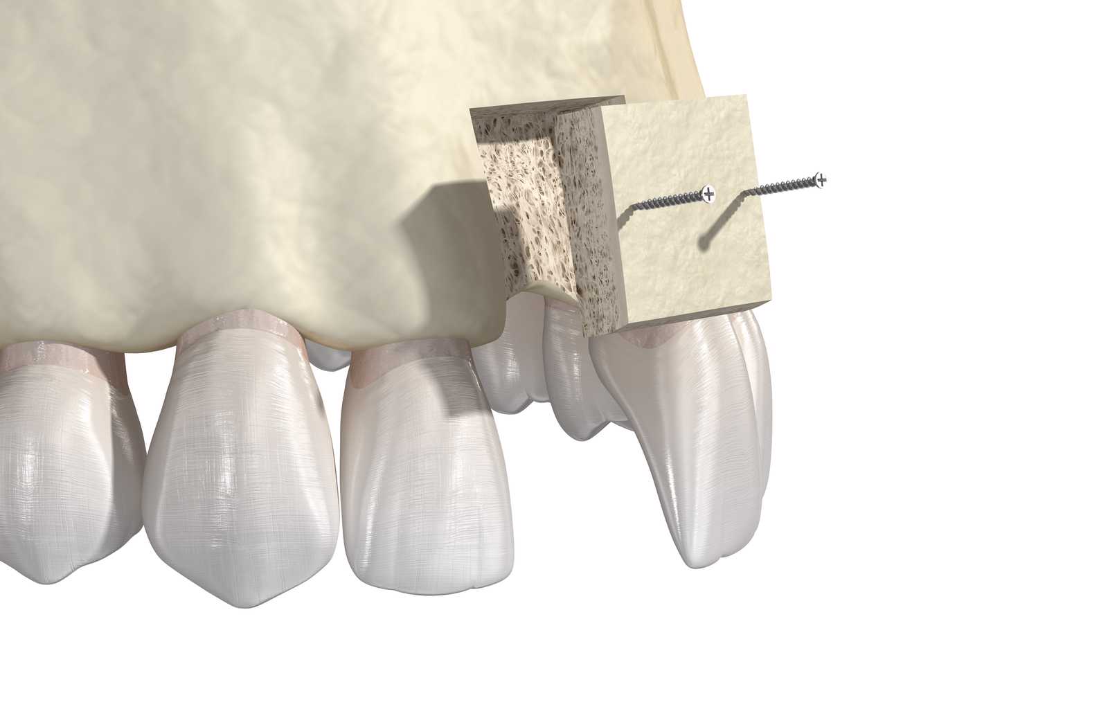 Illustration of a jawline getting a block allograft with pins sticking out on a white background
