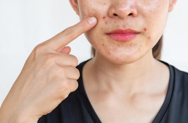 một người phụ nữ đang chỉ tay nên mặt chỗ có nốt mụn