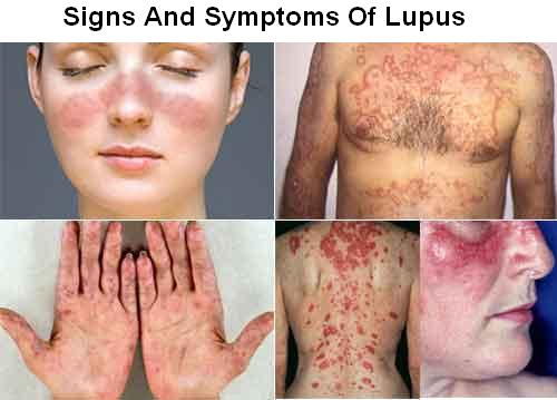 Discoid lupus erythematosus | DermNet New Zealand