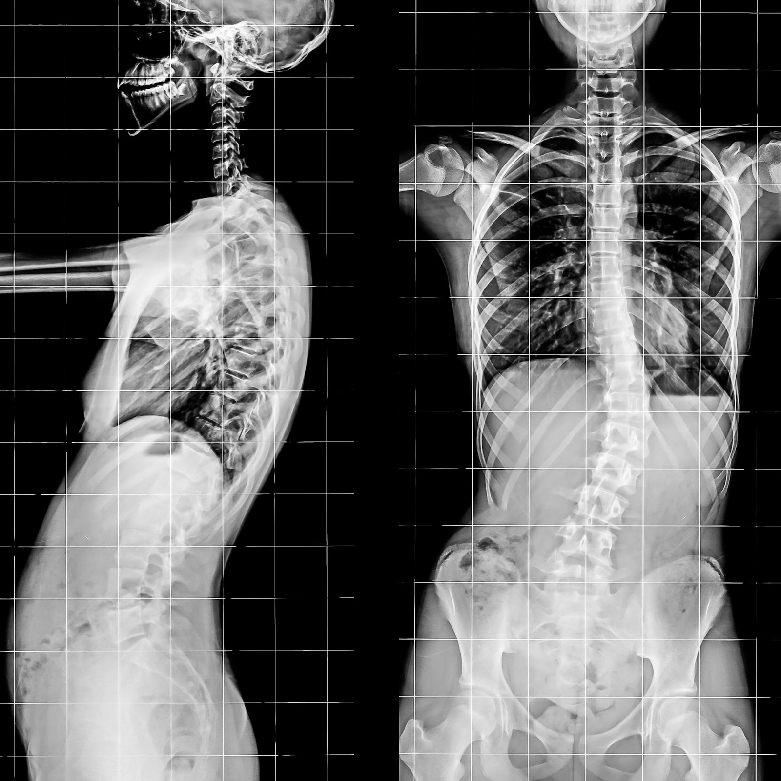 X-ray of the Spinal Column and Pelvis of human skeleton showing moderate scoliosis