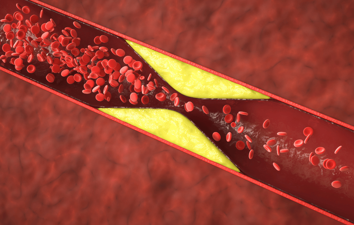 Blood cells moving through an Artery with PAD