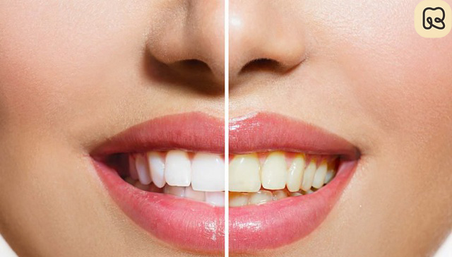 phương pháp tẩy trắng răng phổ biến nhất