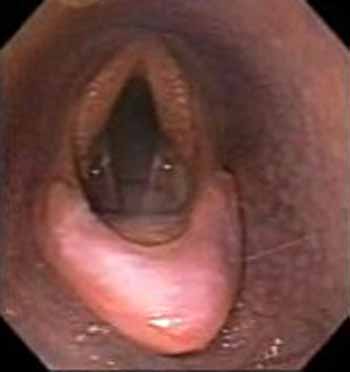 Aryepiglottic fold entrapment. Note the outline of the epiglottic cartilage is visible.