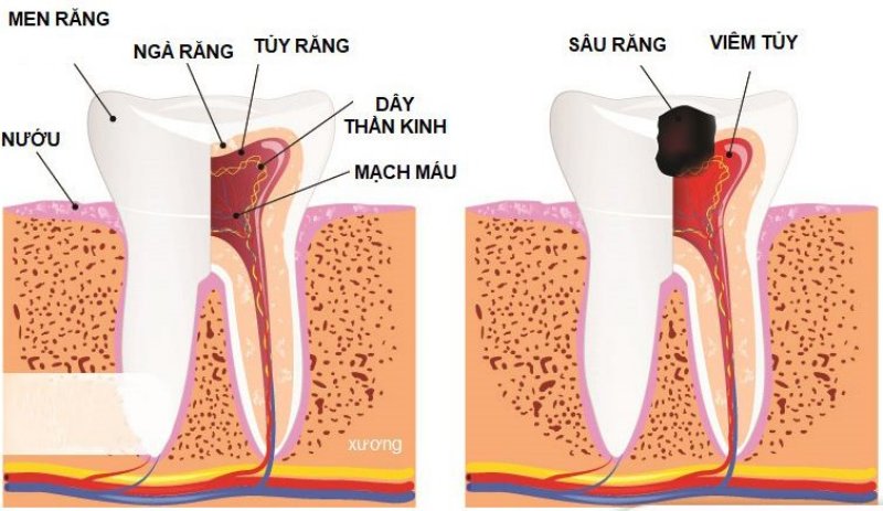 Sâu răng lâu ngày khiến tủy bị tổn thương nghiêm trọng