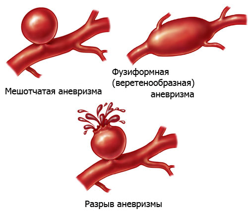 Аневризма дуги аорты симптомы