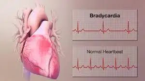 What is bradycardia
