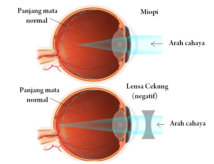 penyakit pada pupil mata - mat anormal dan keluhan