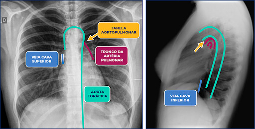 Anatomia radiográfica do coração e dos vasos da base - imagem 1