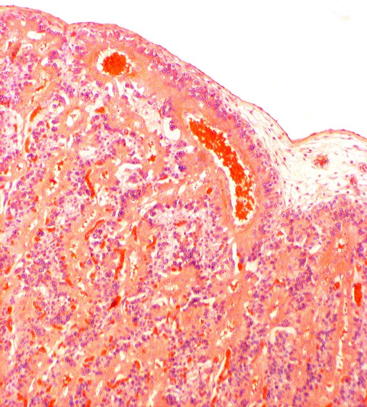 Fetal surface of implanted placenta with red blood in fetal blood vessels.