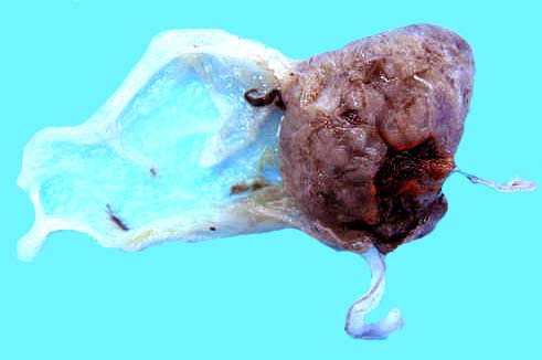Maternal surface after fixation with cord below, and the membranes extending left.