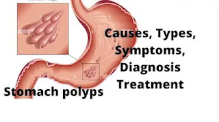 What is a Stomach polyp