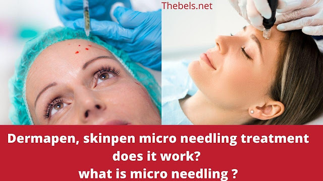 Micro-Needling Treatment Does it Work