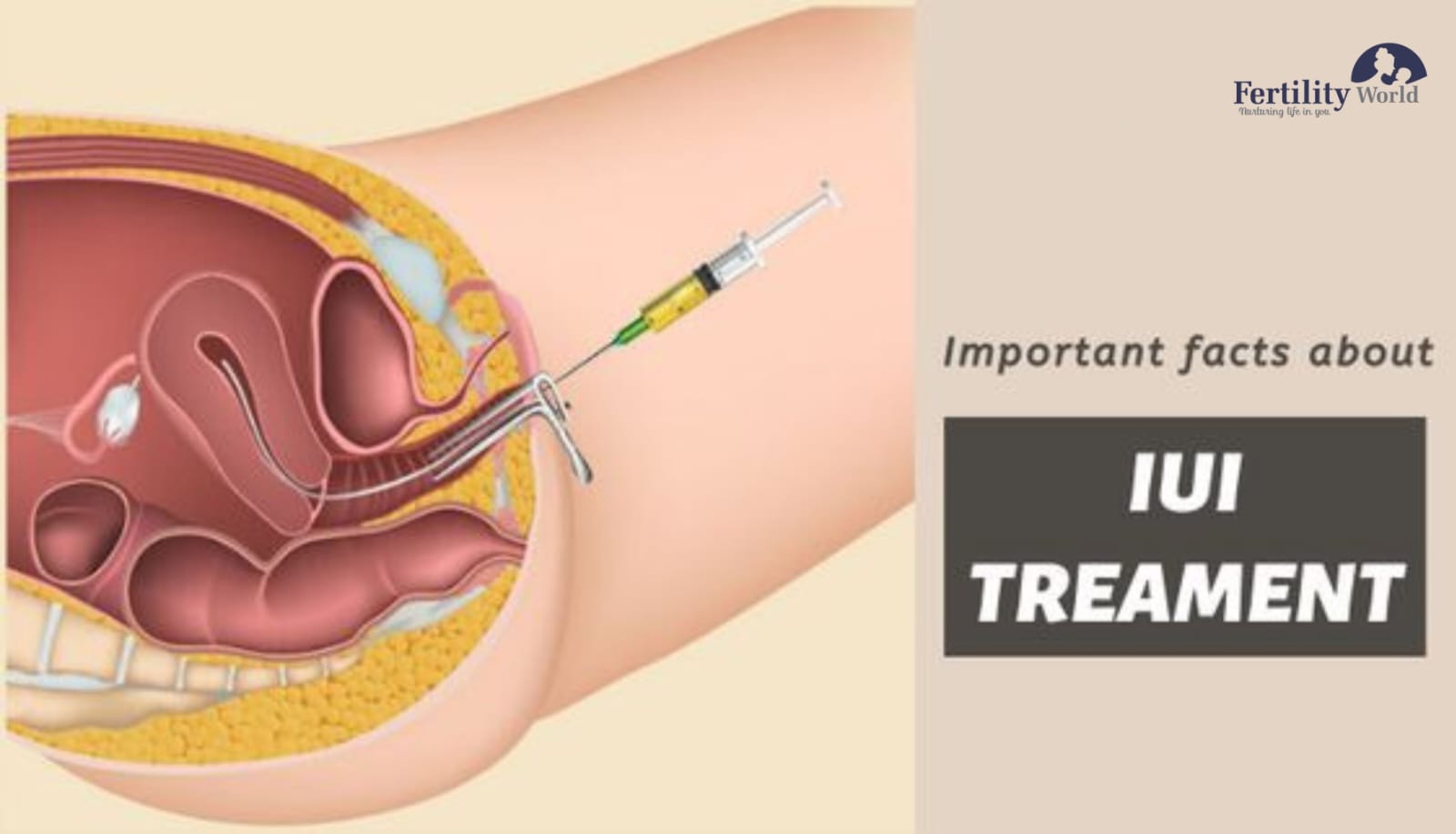 Intrauterine insemination (IUI)