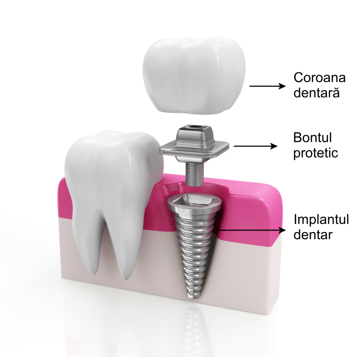Componente implant dentar