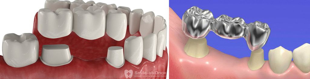 Коронки из металлокерамики и металла