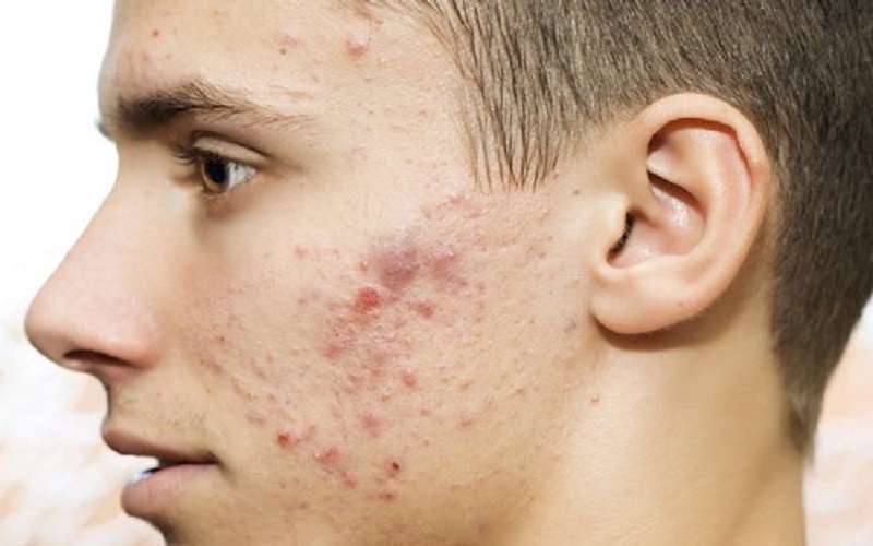 Hiểu rõ về làn da là bước vô cùng quan trọng khi bắt đầu trị mụn