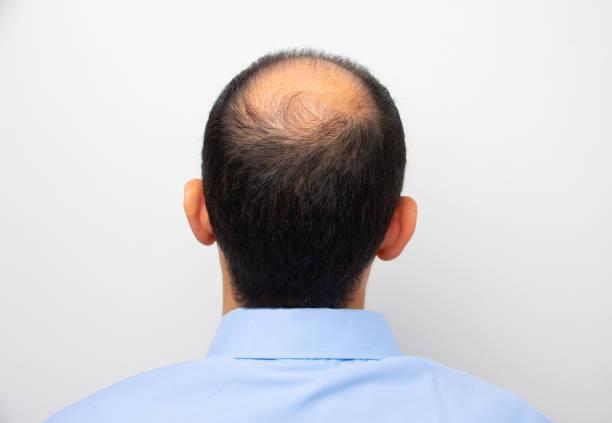 man with alopecia Rear view of a male head with thinning hair or alopecia male pattern baldness stock pictures, royalty-free photos & images
