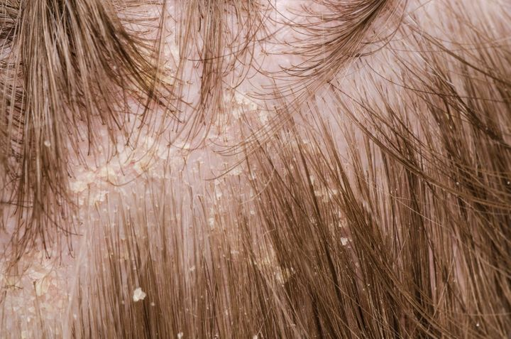 A dry scalp is often caused by unbalanced moisture in the scalp. Source. Huffpost