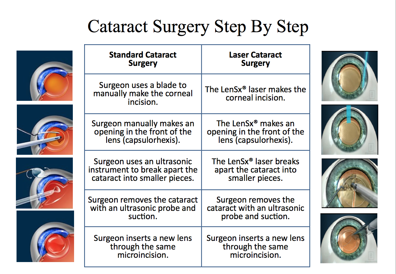 cataracts_illustration.png