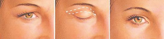 F:\aura\webpage\COSMETIC SURGERIES\blepharoplasty\eyelid-surgery-upper-eyelid-incision.jpg