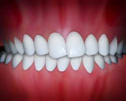 crossbite crossbite