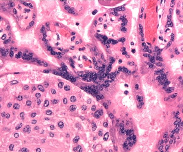 Low power view of term villi and large villus with cytotrophoblastic excess at left. Higher magnification of terminal villi and cytotrophoblast column below